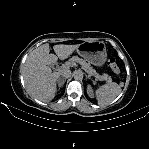 Bilateral benign adrenal adenomas (Radiopaedia 86912-103124 Axial non-contrast 34).jpg