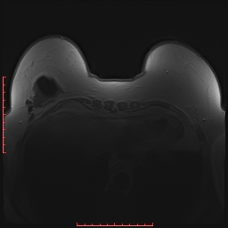 File:Bilateral breast implant rupture (Radiopaedia 24761-25027 PASTA 25).jpg
