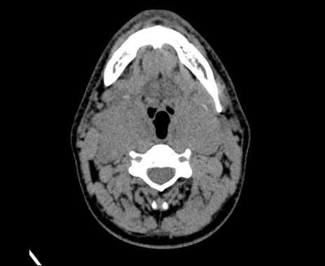 Bilateral carotid body tumors (Radiopaedia 61841-69870 Axial non-contrast 45).jpg