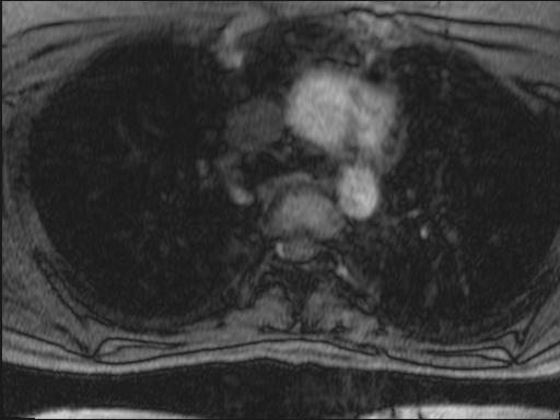 Bilateral carotid body tumors and right glomus jugulare tumor (Radiopaedia 20024-20060 Axial MRA 143).jpg