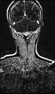 Bilateral carotid body tumors and right glomus jugulare tumor (Radiopaedia 20024-20060 MRA 139).jpg