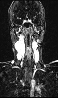 File:Bilateral carotid body tumors and right glomus jugulare tumor (Radiopaedia 20024-20060 MRA 98).jpg