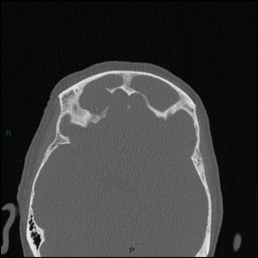 Bilateral frontal mucoceles (Radiopaedia 82352-96454 Axial bone window 103).jpg