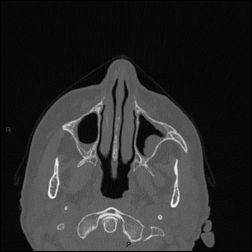 File:Bilateral frontal mucoceles (Radiopaedia 82352-96454 Axial bone window 214).jpg