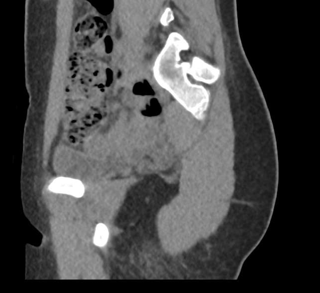 File:Bilateral mature cystic ovarian teratoma (Radiopaedia 88821-105592 D 13).jpg