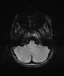 Bilateral mesial temporal polymicrogyria (Radiopaedia 76456-88181 Axial SWI 7).jpg