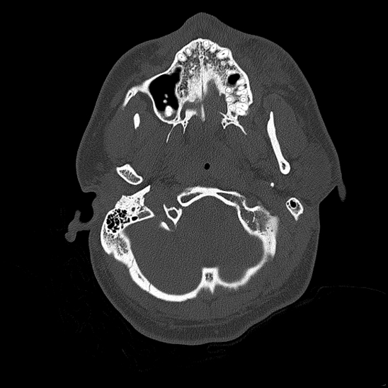 Bilateral occipital condyle fracture (type 2) (Radiopaedia 87675-104089 Axial bone thins 26).jpg