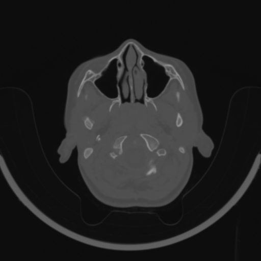Bilateral otosclerosis (Radiopaedia 57237-64157 C 4).jpg