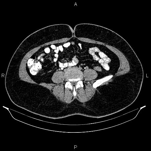 Bilateral ovarian dermoid cysts (Radiopaedia 85785-101603 Axial C+ delayed 48).jpg