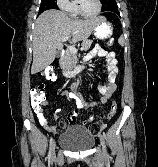 File:Bilateral ovarian dermoid cysts (Radiopaedia 85785-101603 C 19).jpg