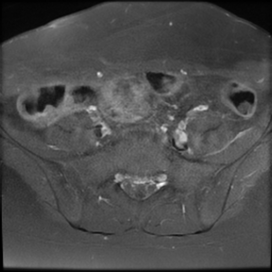 File:Bilateral ovarian fibrothecomas - adolescent (Radiopaedia 86604-102707 Axial T1 C+ fat sat 6).jpg