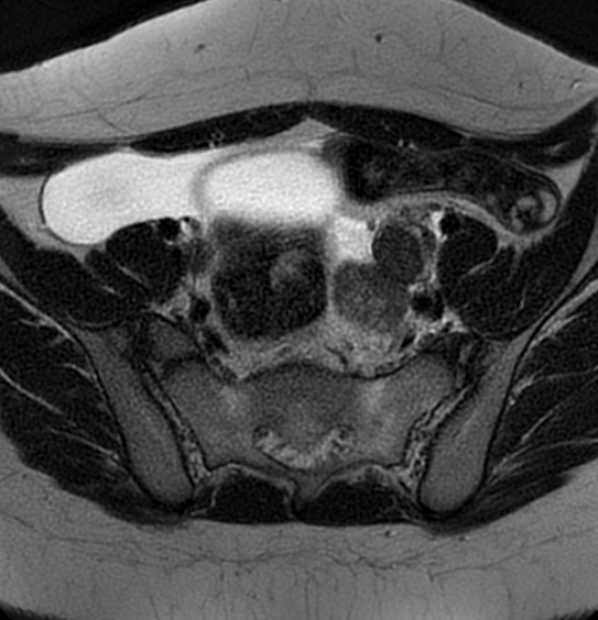 File:Bilateral ovarian fibrothecomas - adolescent (Radiopaedia 86604-102707 Axial T2 13).jpg
