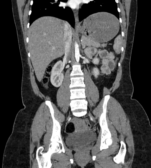 Bilateral ovarian mature cystic teratomas (Radiopaedia 79373-92457 B 46).jpg