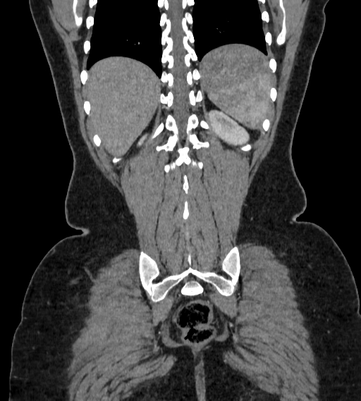 Bilateral ovarian mature cystic teratomas (Radiopaedia 79373-92457 B 88).jpg