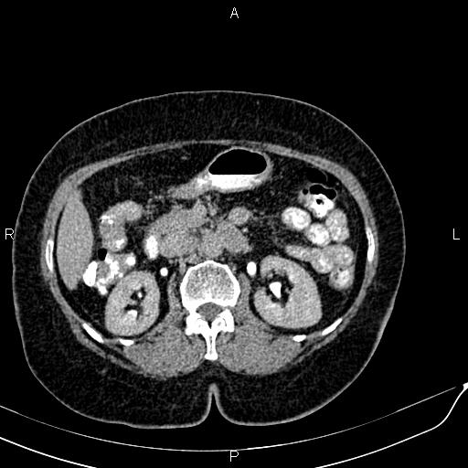 File:Bilateral ovarian serous cystadenocarcinoma (Radiopaedia 86062-101989 Axial C+ delayed 23).jpg