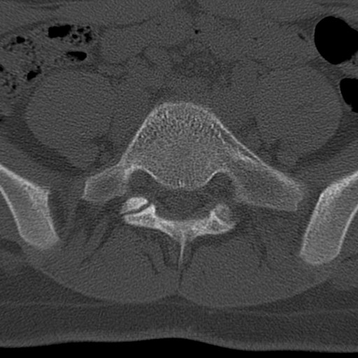 Bilateral pars defect (Radiopaedia 26691-26846 Axial bone window 60).jpg