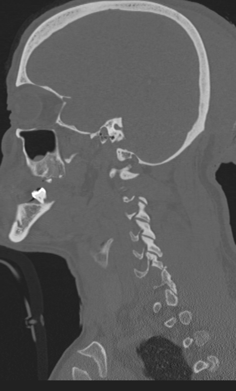 Bilateral perched facet joint (Radiopaedia 63149-71669 Sagittal bone window 61).jpg