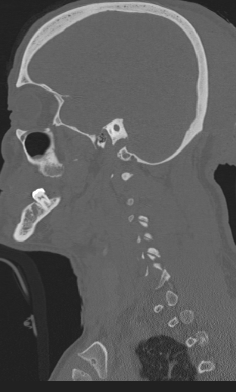 Bilateral perched facet joint (Radiopaedia 63149-71669 Sagittal bone window 65).jpg
