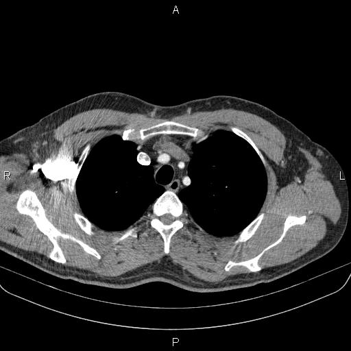 Bilateral pulmonary AVM (Radiopaedia 83134-97505 A 15).jpg