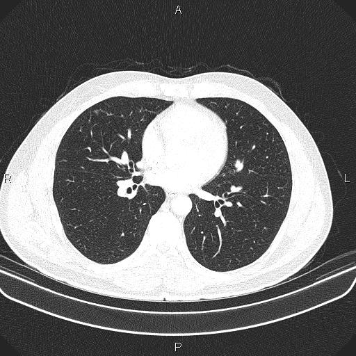 File:Bilateral pulmonary AVM (Radiopaedia 83134-97505 Axial lung window 42).jpg