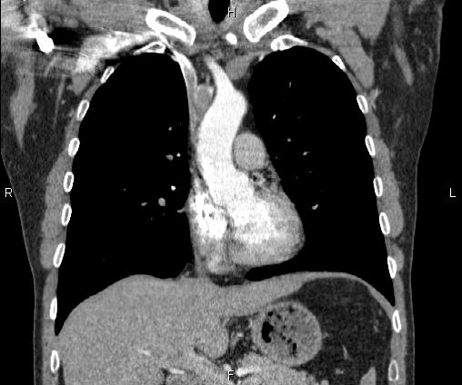 File:Bilateral pulmonary AVM (Radiopaedia 83134-97505 C 32).jpg