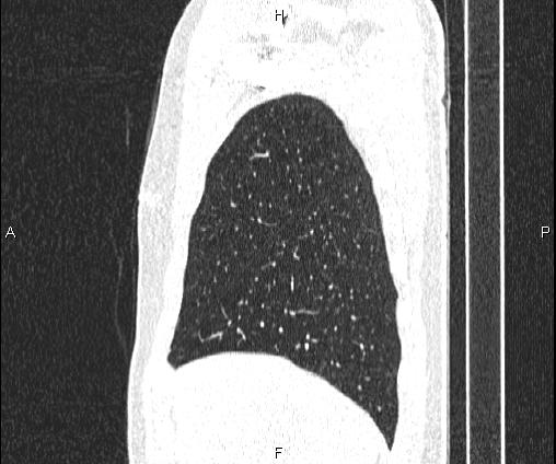 File:Bilateral pulmonary AVM (Radiopaedia 83134-97505 Sagittal lung window 27).jpg