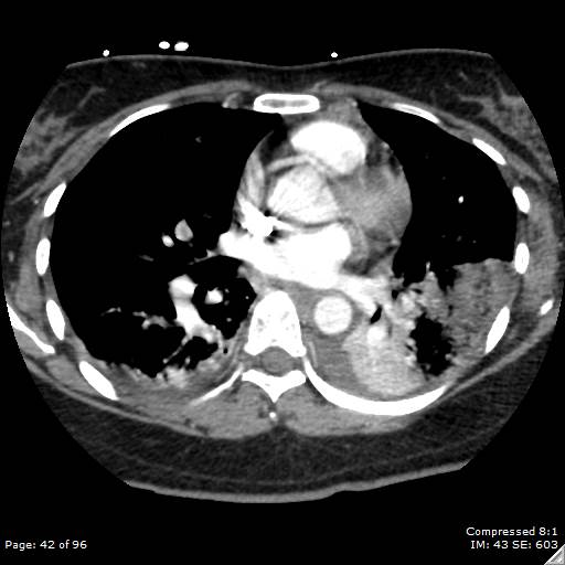 Bilateral pulmonary emboli with Hampton hump sign (Radiopaedia 54070-60246 Axial C+ CTPA 39).jpg