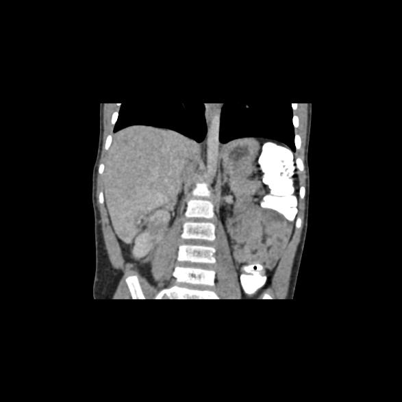 File:Bilateral renal malrotation (Radiopaedia 30901-31606 B 5).jpg
