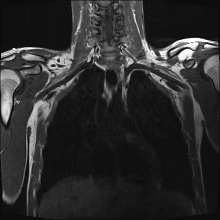 File:Bilateral spinoglenoid notch ganglion cysts (Radiopaedia 29577-30082 Coronal T1 12).jpg