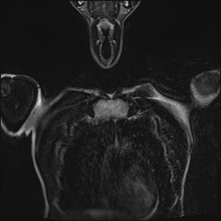 Bilateral spinoglenoid notch ganglion cysts (Radiopaedia 29577-30082 Coronal T2 17).jpg