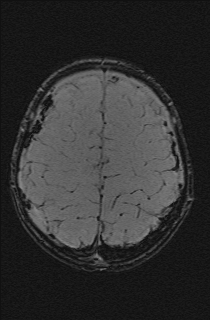 Bilateral subdural hemorrhage and parietal skull fracture (Radiopaedia 26058-26190 Axial SWI 65).png