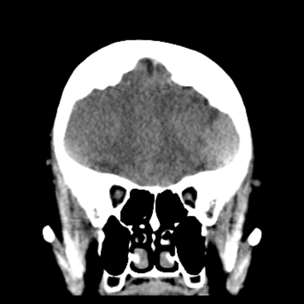Bilateral subdural hemorrhages (Radiopaedia 26588-26732 Coronal non-contrast 18).jpg