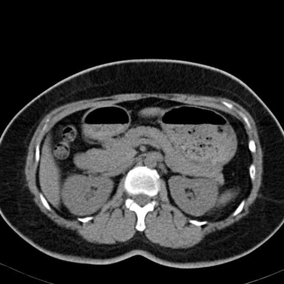 File:Bilateral ureteric stents (Radiopaedia 48795-53825 Axial non-contrast 19).jpg