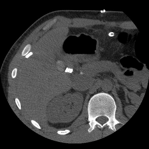 Bile leak from liver traumatic laceration (Radiopaedia 63463-72077 Axial Biliscopin 47).jpg