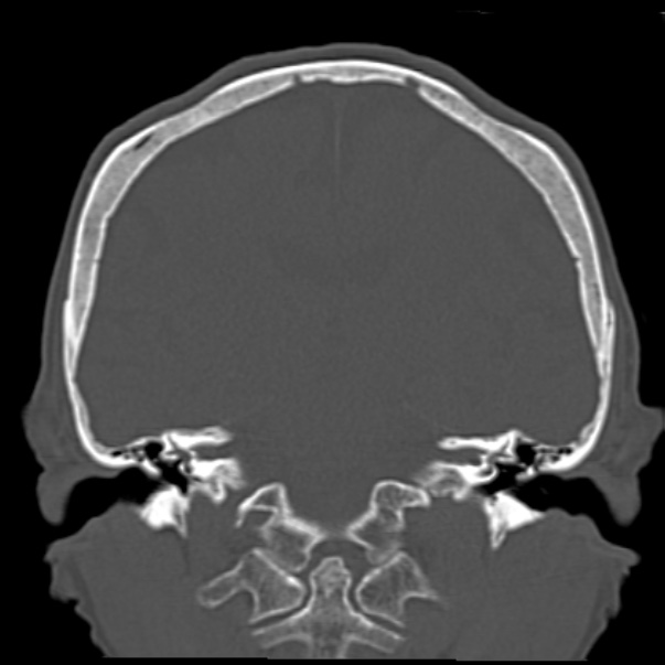 Biparietal osteodystrophy (Radiopaedia 46109-50463 Coronal bone window 61).jpg