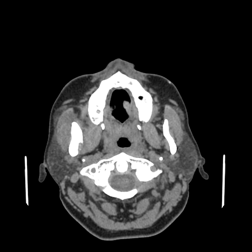Bisphosphonate-related osteonecrosis of the jaw (Radiopaedia 71324-81642 non-contrast 110).jpg