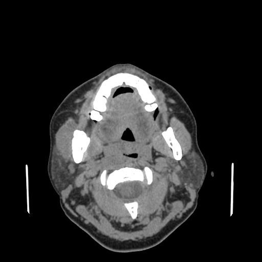 Bisphosphonate-related osteonecrosis of the jaw (Radiopaedia 71324-81642 non-contrast 93).jpg