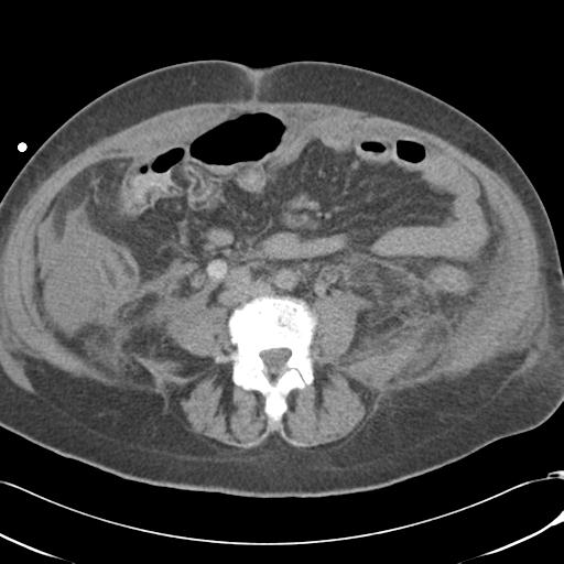 Bladder rupture post renal biopsy (Radiopaedia 30863-31572 Axial non-contrast 52).jpg