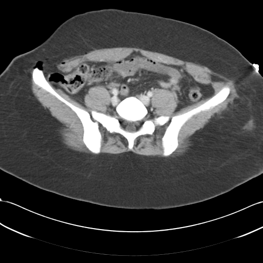 File:Blood in uterovesical and rectovesical pouch in trauma patient (Radiopaedia 34090-35340 C 37).png