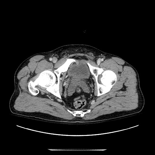 Blunt abdominal trauma with solid organ and musculoskelatal injury with active extravasation (Radiopaedia 68364-77895 A 148).jpg