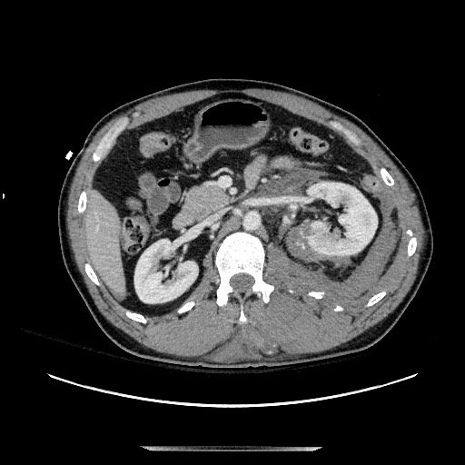Blunt abdominal trauma with solid organ and musculoskelatal injury with active extravasation (Radiopaedia 68364-77895 A 56).jpg