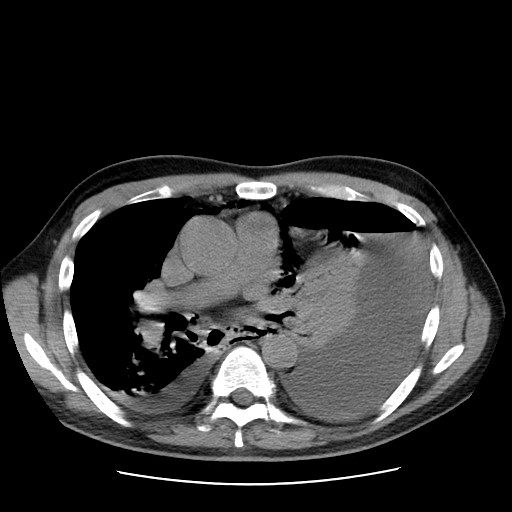 Boerhaave syndrome (Radiopaedia 59796-67310 Axial liver window 32).jpg
