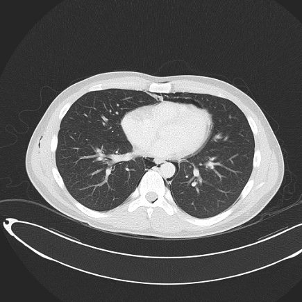 Boerhaave syndrome with mediastinal, axillary, neck and epidural free gas (Radiopaedia 41297-44115 Axial lung window 59).jpg