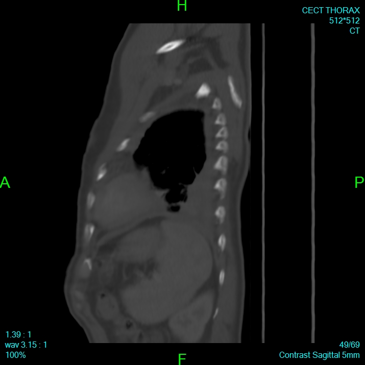 Bone metastases from lung carcinoma (Radiopaedia 54703-60937 Sagittal bone window 49).jpg