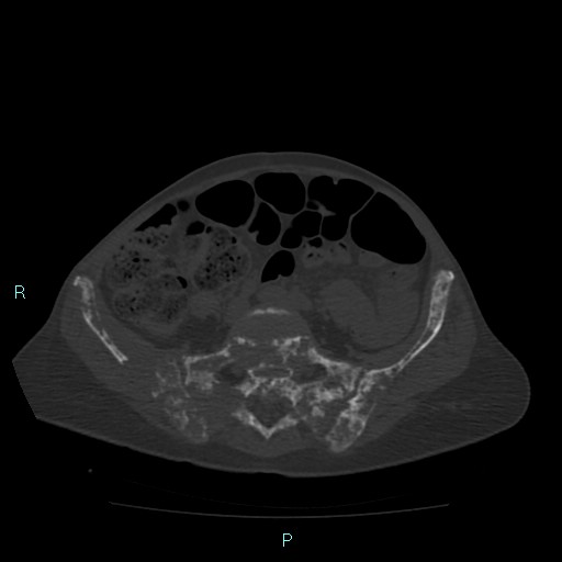 Bone metastases from untreated breast cancer (Radiopaedia 42973-46219 Axial bone window 147).jpg
