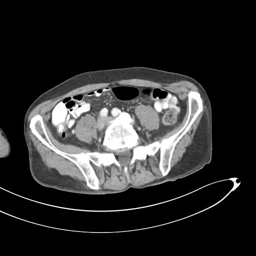 Bone metastasis from squamous cell carcinoma (Radiopaedia 30133-30730 B 50).jpg