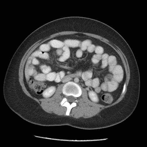 File:Borderline mucinous tumor (ovary) (Radiopaedia 78228-90808 A 90).jpg