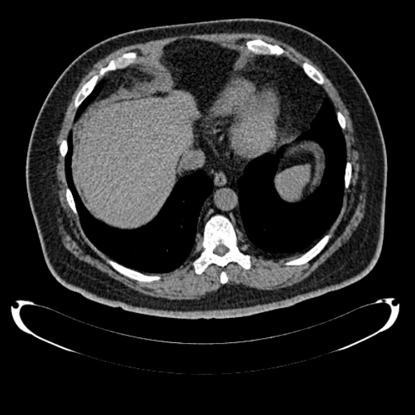 Bosniak renal cyst - type IV (Radiopaedia 24244-24518 Axial non-contrast 38).jpg