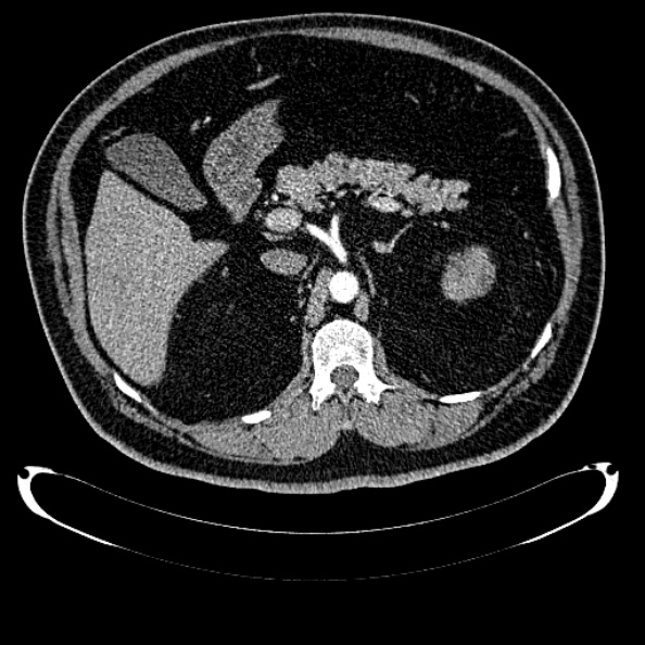 Bosniak renal cyst - type IV (Radiopaedia 24244-24518 B 105).jpg