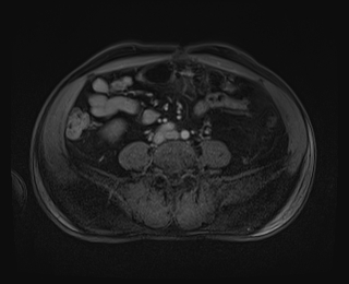 Bouveret syndrome (Radiopaedia 61017-68856 Axial T1 C+ fat sat 65).jpg